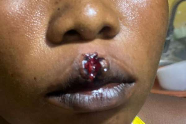 Woman Attacked During Robbery Attempt Akatsi