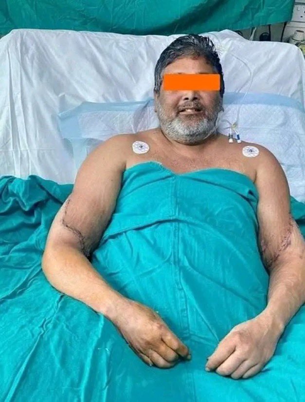 Indian Doctors Achieve Rare Double Hand Transplant for Painter After Train Accident
